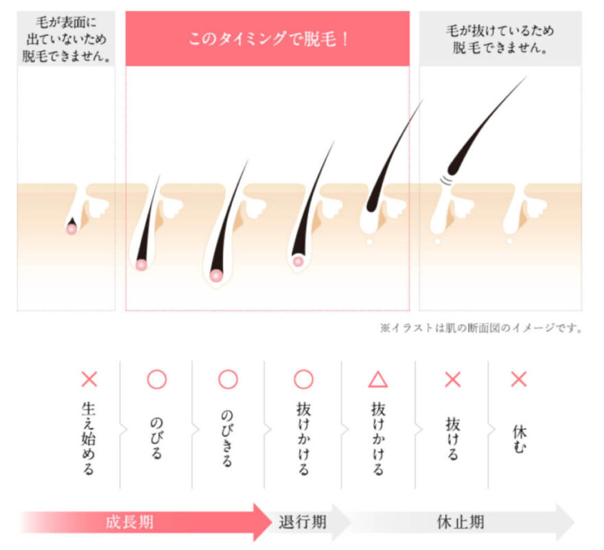 販売 tbc スーパー 脱毛 40 本 どのくらい